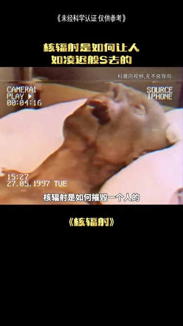 被核辐射人照片,日本核辐射死亡事件图片