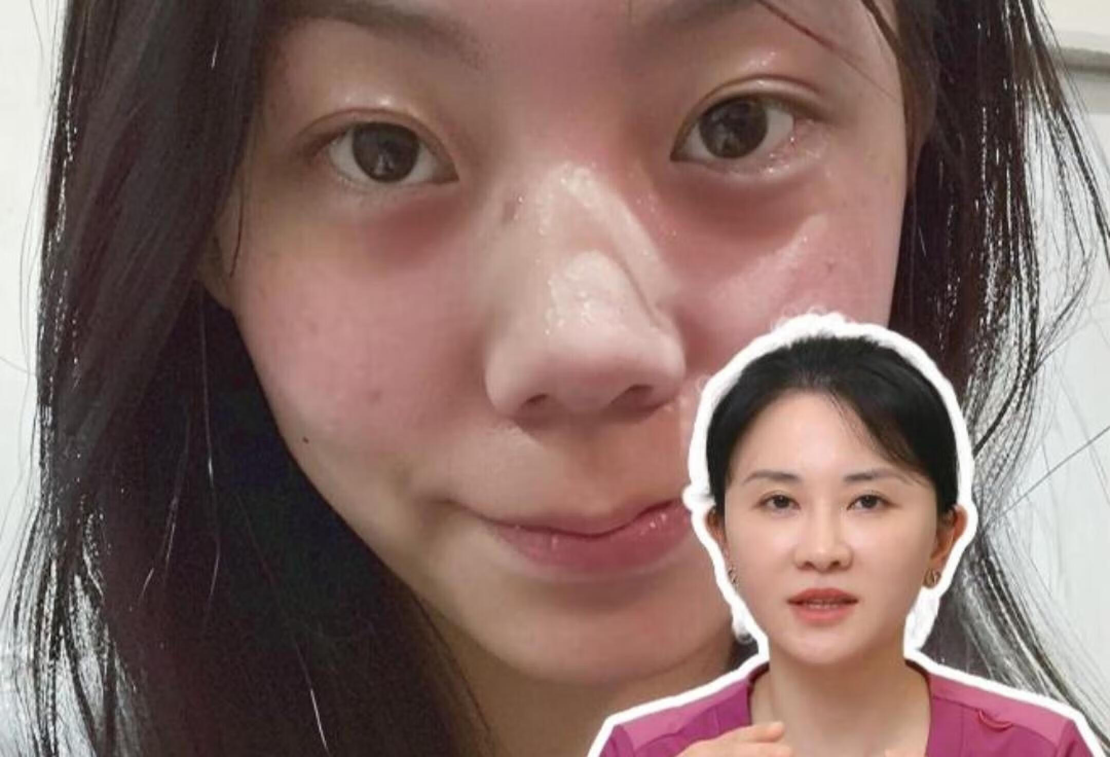 卟啉病真实患者图片,卟啉病症状图片