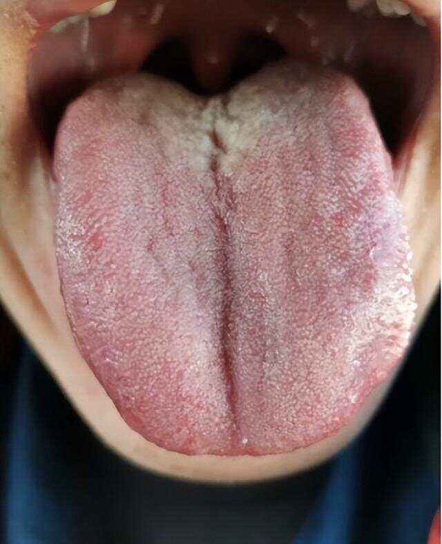 正常人上火的舌头图片,肝火旺的舌头图片大全