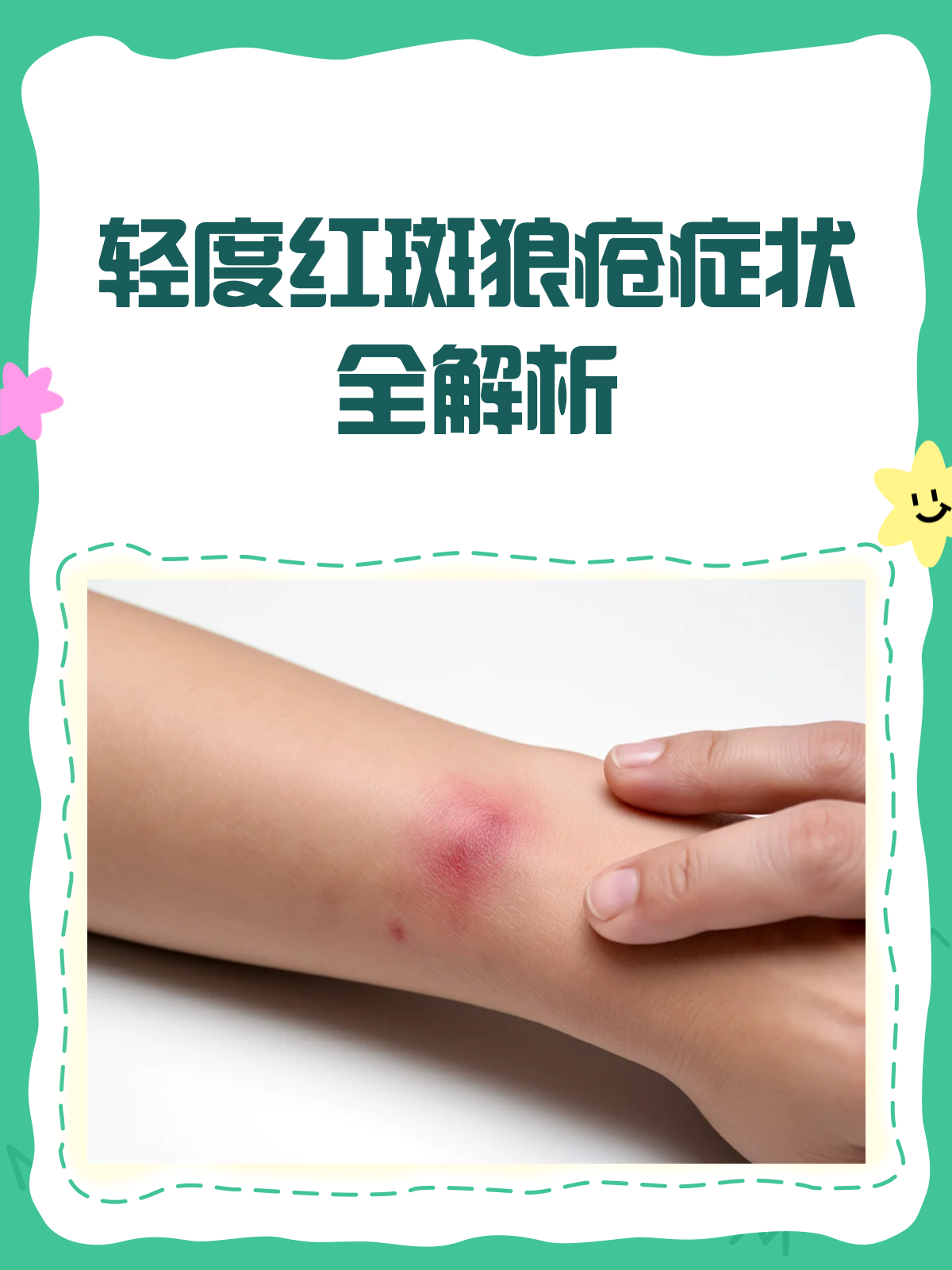 红斑狼疮早期症状图片,轻度红斑狼疮早期症状图片