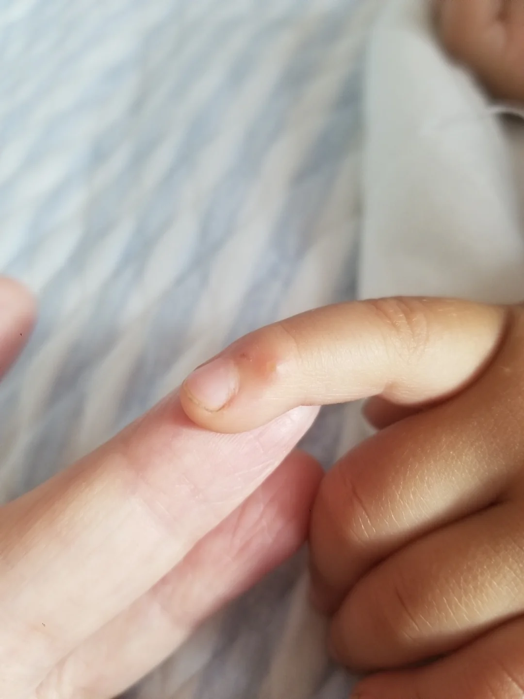 儿童手指上长水泡图片,小孩手指上长水泡