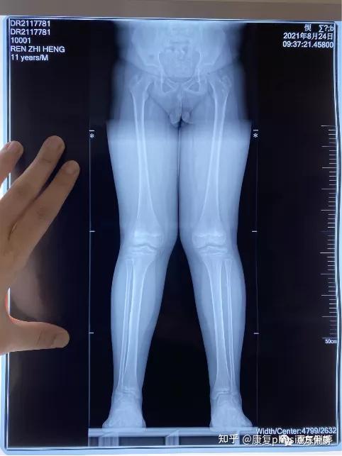 x型腿图片,严重x型腿图片